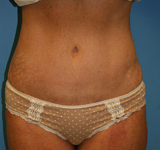 slimlipo after