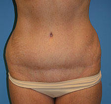 SlimLipo before