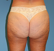 slimlipo after
