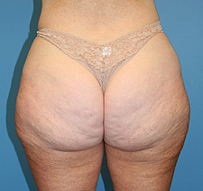 slimlipo liposculpture after