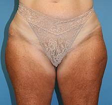 slimlipo before