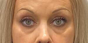 Restylane tear trough before