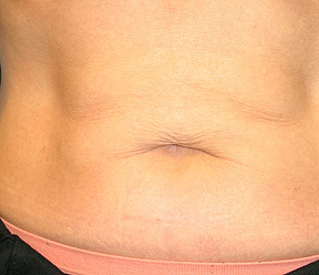 thermage after