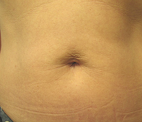 thermage before