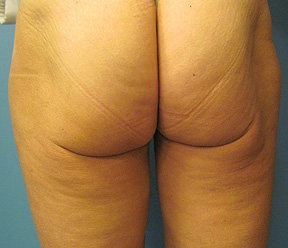 abdominal thermage