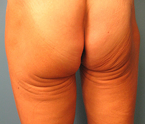 body by thermage