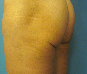 thermage after