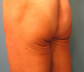 thermage before