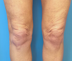 knees thermage after