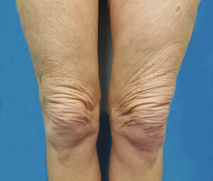 knees thermage before