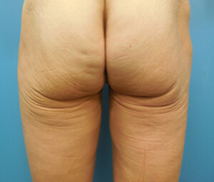 thermage buttocks before