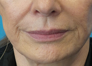 juvederm volbella after