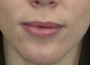 juvederm volbella after