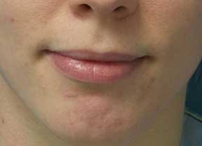 juvederm volbella before