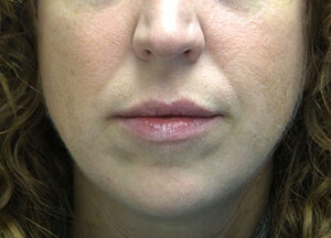 juvederm volbella after