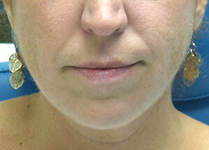 juvederm volbella before