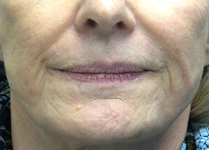 juvederm volbella before