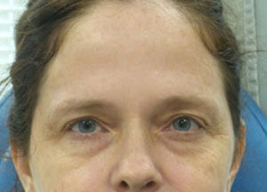 treatment botox