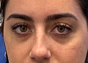 xeomin after