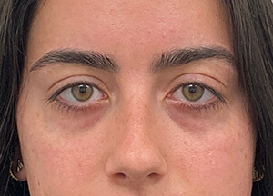 xeomin before