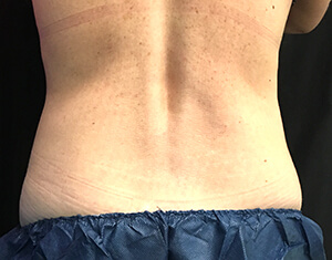 Coolsculpting After