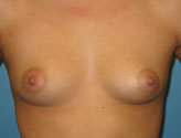 pre-op