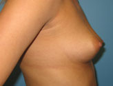 pre-op