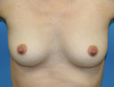 Breast Augmentation Before