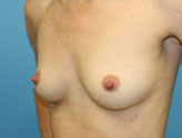 Breast Augmentation Before