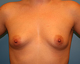 pre-op