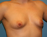 pre-op