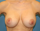 post-op