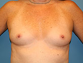 implant before