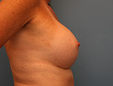 after implant