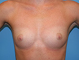 breast aug b