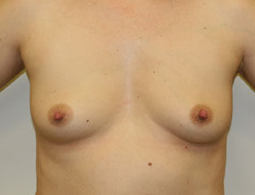 Breast Implants Before