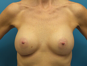 Breast Implant After