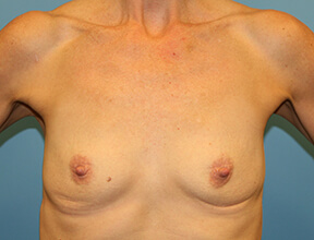 Breast Implants Before