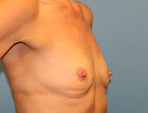 Breast Implants Before