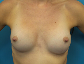 Breast Implant After