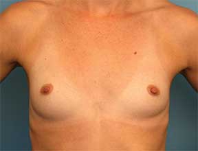 Breast Implants Before