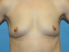 Breast Implants Before