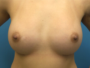 Breast Augmentation After