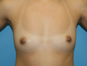 Breast Augmentation Before