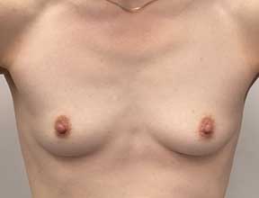 Breast Augmention Before