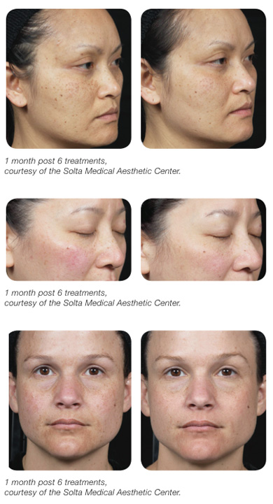 Clear + Brilliant before and after photos