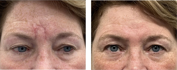 laser scar treatment before and after