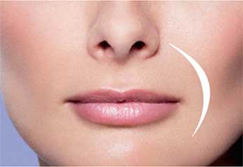 Juvederm