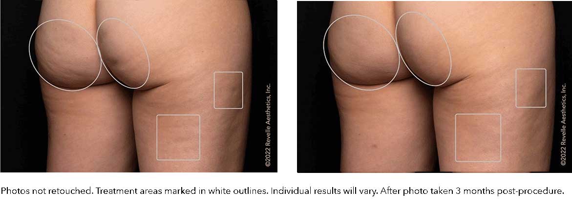 Cellulite Treatment