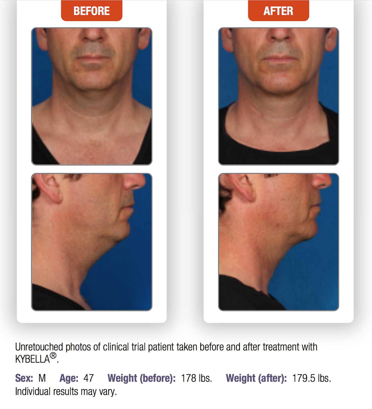 Kybella for Double Chin - Boston South Shore - Dr. Hamori